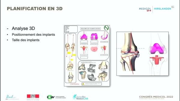 Is pre-operative 3D planning still relevant?